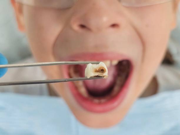 Best Emergency Treatment for Dental Infections or Abscesses in Joseph City, AZ